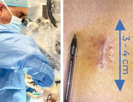 Microdiscectomía lumbar