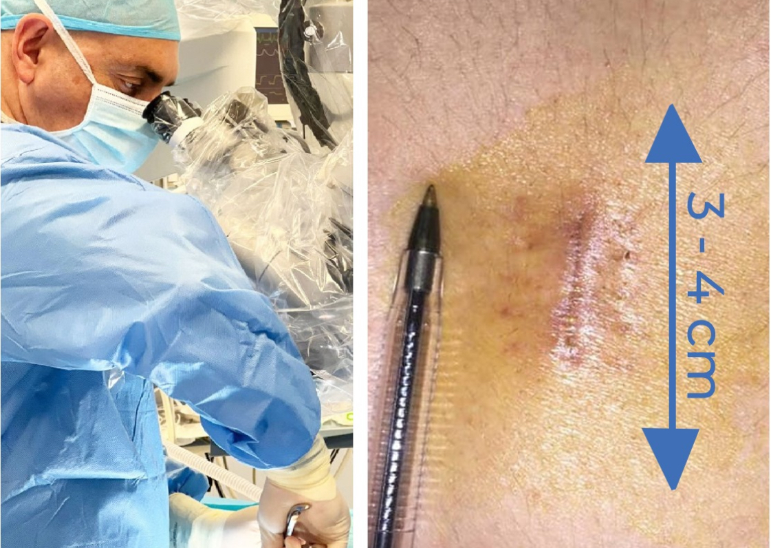 Microdiscectomía lumbar