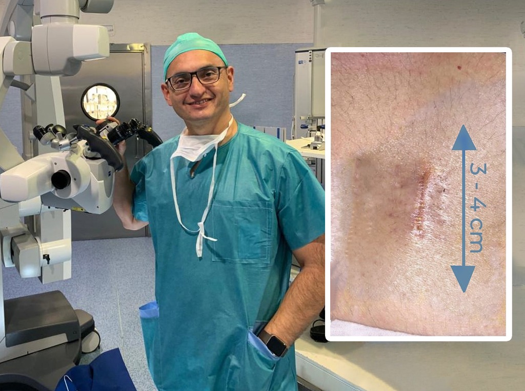 Dr. Bernardo Mosqueira realizando cirugía mínimamente invasiva de columna en España mostrando la pequeña incisión quirúrgica